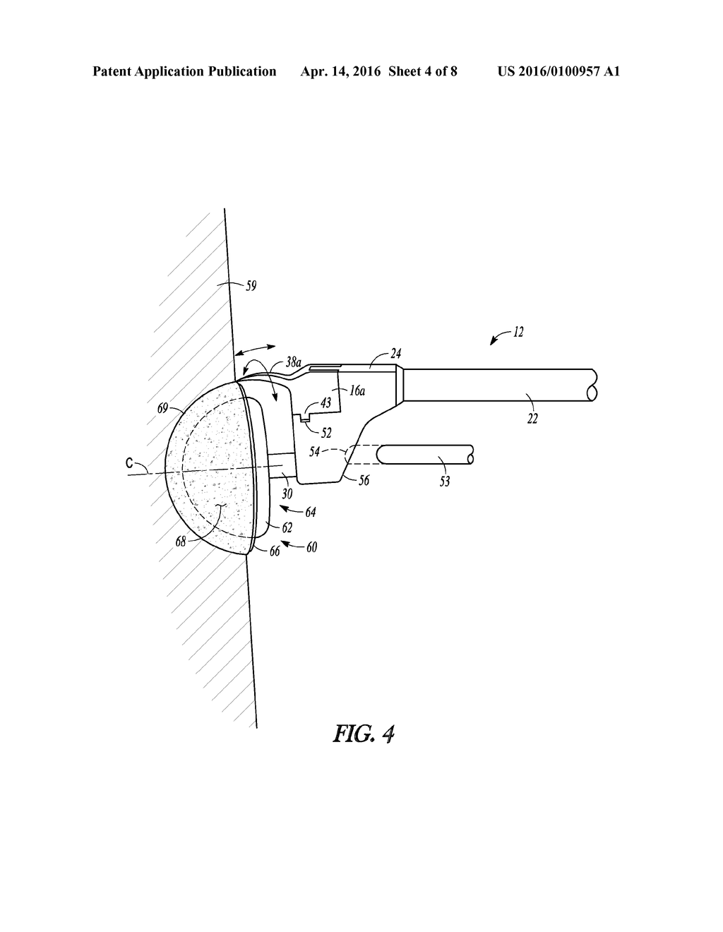 ACETABULAR EXPLANT APPARATUS, SYSTEM, AND METHOD - diagram, schematic, and image 05