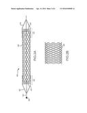 METHODS AND APPARATUS FOR LUMINAL STENTING diagram and image