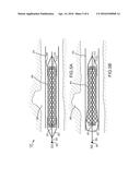 METHODS AND APPARATUS FOR LUMINAL STENTING diagram and image