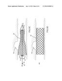 METHODS AND APPARATUS FOR LUMINAL STENTING diagram and image