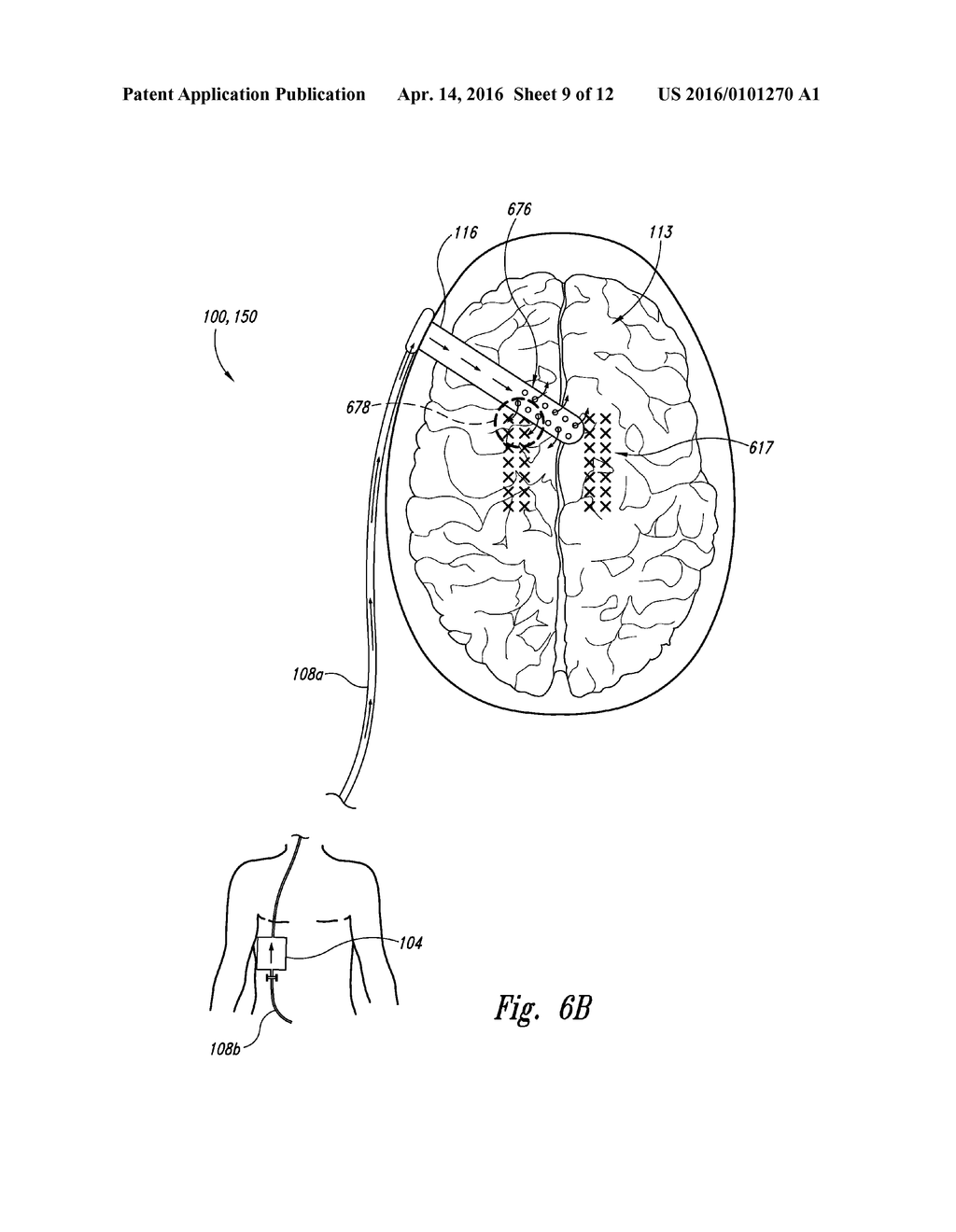 DRAINAGE SYSTEMS FOR EXCESS BODY FLUIDS AND ASSOCIATED METHODS - diagram, schematic, and image 10