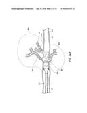 CATHETER-ASSISTED TUMOR TREATMENT diagram and image