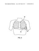 IMPLANTABLE CARDIO DEFIBRILLATOR (ICD), SUBCUTANEOUS IMPLANTABLE CARDIO     DEFIBRILLATOR (SICD), AND WAVEFORM ENERGY CONTROL SYSTEMS diagram and image