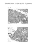 METHOD FOR DETERMINING PROGNOSIS OF CANCER diagram and image