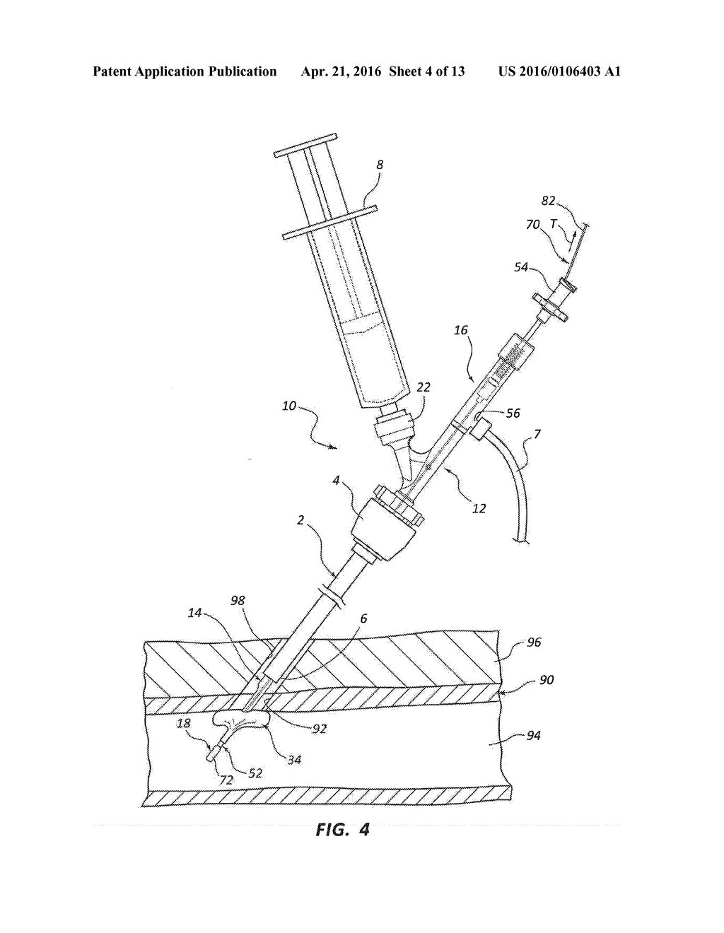 BIORESORBABLE DETACHABLE TIP DESIGN FOR ADHESIVE-BASED EXTRAVASCULAR     CLOSURE DEVICE - diagram, schematic, and image 05