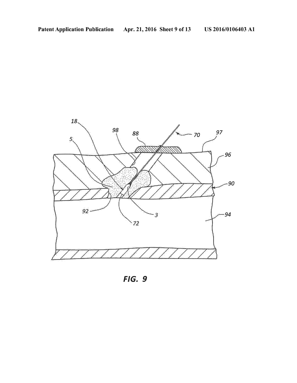 BIORESORBABLE DETACHABLE TIP DESIGN FOR ADHESIVE-BASED EXTRAVASCULAR     CLOSURE DEVICE - diagram, schematic, and image 10