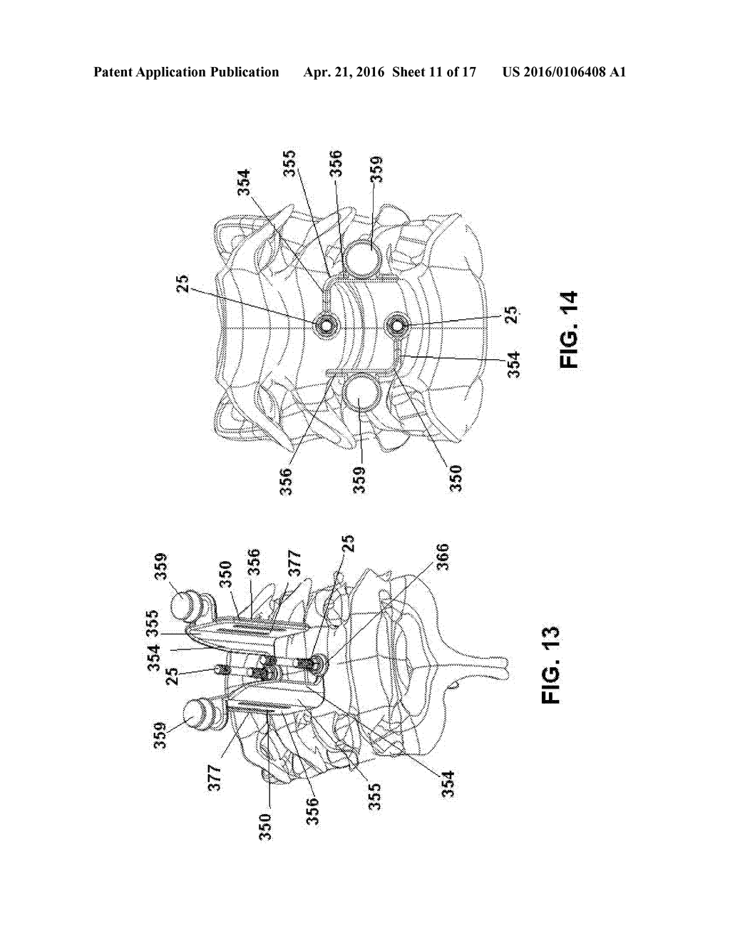 Orthopedic Tools for Implantation - diagram, schematic, and image 12