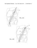 METHOD AND APPARATUS FOR COUPLING SOFT TISSUE TO A BONE diagram and image