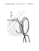 SUTURE STITCHES FOR CONTINUOUS SURGICAL SUTURING diagram and image