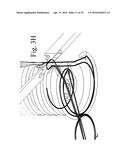 SUTURE STITCHES FOR CONTINUOUS SURGICAL SUTURING diagram and image