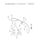 SYSTEMS AND METHOD FOR LEFT ATRIAL APPENDAGE OBLITERATION diagram and image