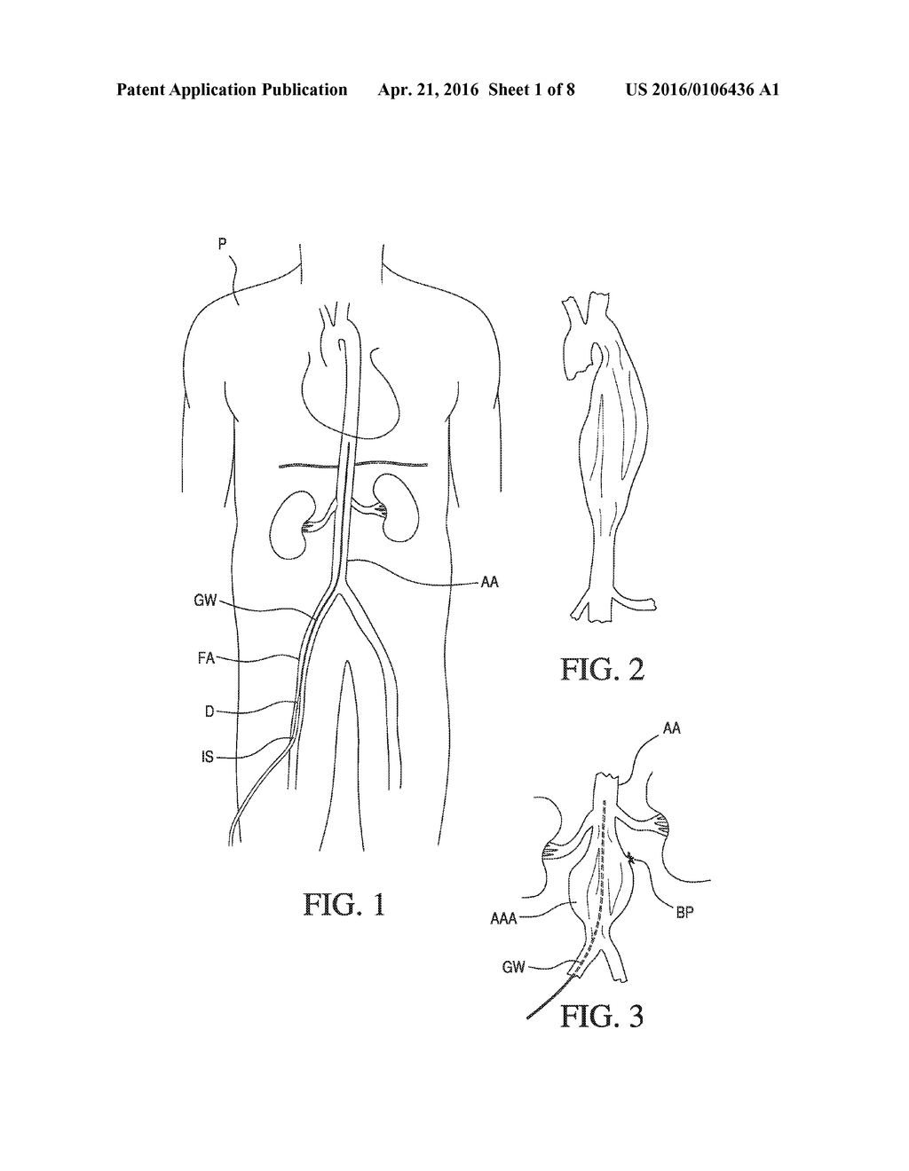 Vascular Dilator for Controlling Blood Flow in a Blood Vessel - diagram, schematic, and image 02