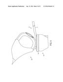 System for Articular Surface Replacement diagram and image