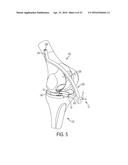 System for Articular Surface Replacement diagram and image