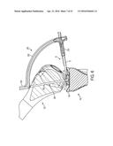 System for Articular Surface Replacement diagram and image