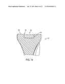 System for Articular Surface Replacement diagram and image