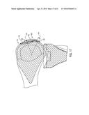 System for Articular Surface Replacement diagram and image