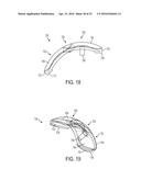 System for Articular Surface Replacement diagram and image