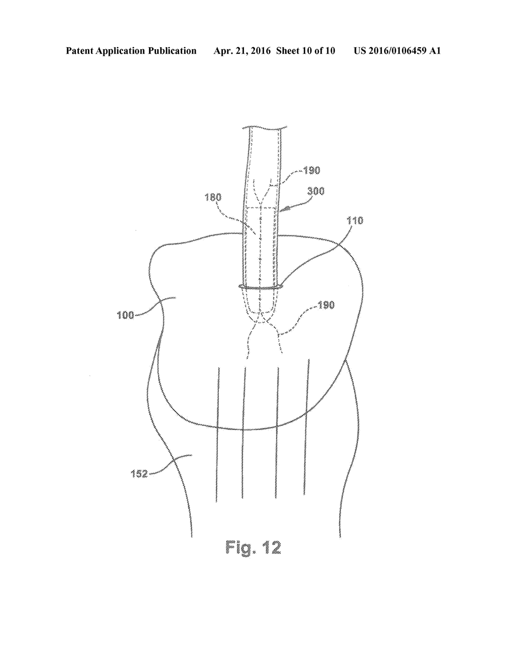 DEVICES AND METHODS FOR TISSUE GRAFT DELIVERY - diagram, schematic, and image 11