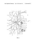 SURGICAL SYSTEM AND METHOD diagram and image