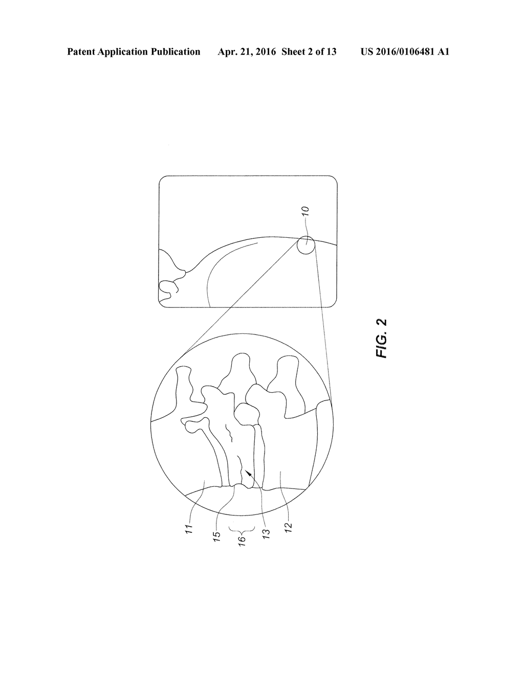 Systems and Methods for Performing Spinal Surgery - diagram, schematic, and image 03