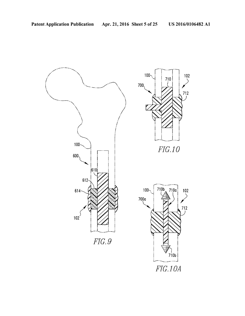 FRACTURE FIXATION SYSTEMS - diagram, schematic, and image 06