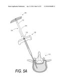 BONE TREATMENT SYSTEMS AND METHODS diagram and image