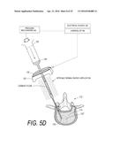 BONE TREATMENT SYSTEMS AND METHODS diagram and image