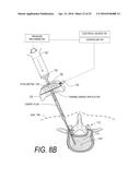 BONE TREATMENT SYSTEMS AND METHODS diagram and image