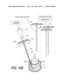 BONE TREATMENT SYSTEMS AND METHODS diagram and image