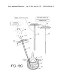 BONE TREATMENT SYSTEMS AND METHODS diagram and image