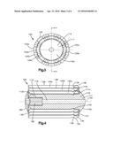 Nested Expandable Sleeve Implant diagram and image