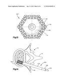 Nested Expandable Sleeve Implant diagram and image