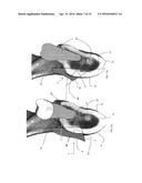 METHOD FOR MAKING A SURGICAL GUIDE FOR BONE HARVESTING diagram and image