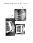 METHOD FOR MAKING A SURGICAL GUIDE FOR BONE HARVESTING diagram and image