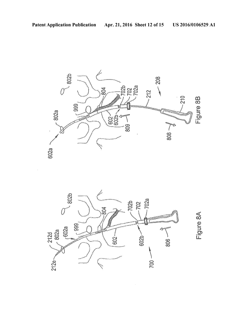 SYSTEMS AND METHODS EMPLOYING A PUSH TUBE FOR DELIVERING A URETHRAL SLING - diagram, schematic, and image 13