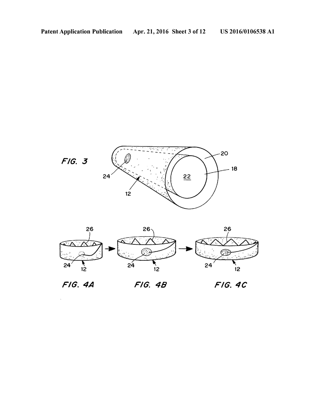 Means for Controlled Sealing of Endovascular Devices - diagram, schematic, and image 04