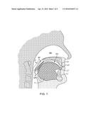 ORAL DEVICE FOR MANDIBULAR ADVANCEMENT AND MEDIAL TONGUE CONSTRAINT diagram and image