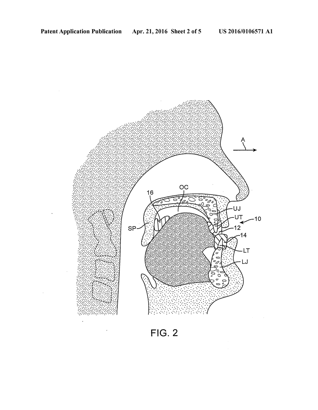 ORAL DEVICE FOR MANDIBULAR ADVANCEMENT AND MEDIAL TONGUE CONSTRAINT - diagram, schematic, and image 03