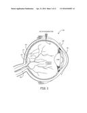 OCULAR GELS OR HYDROGELS AND MICROINJECTORS diagram and image