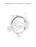 OCULAR GELS OR HYDROGELS AND MICROINJECTORS diagram and image