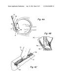 Devices and Methods Useable for Treatment of Glaucoma and Other Surgical     Prcedures diagram and image