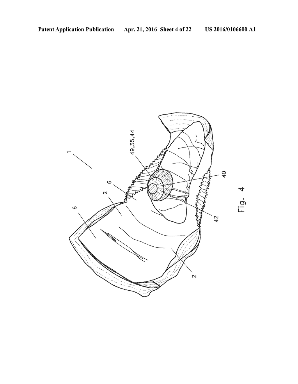 Female Incontinence System - diagram, schematic, and image 05