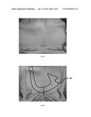 METHODS TO SENSE AND TREAT SUBCLINICAL SKIN DAMAGE diagram and image