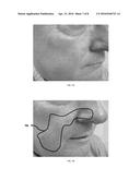 METHODS TO SENSE AND TREAT SUBCLINICAL SKIN DAMAGE diagram and image