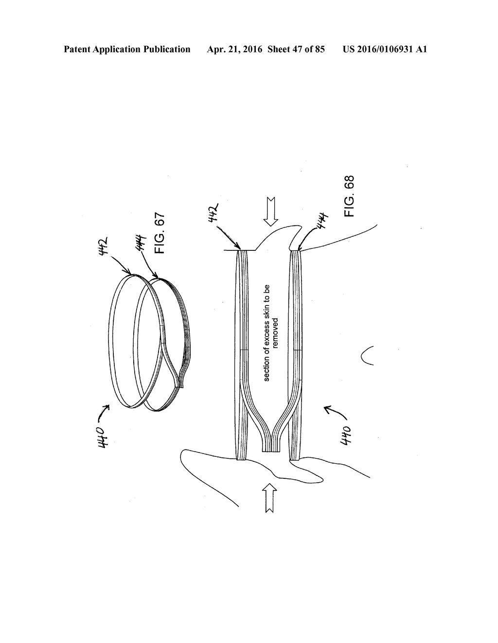 RAPID CLOSING SURGICAL CLOSURE DEVICE - diagram, schematic, and image 48