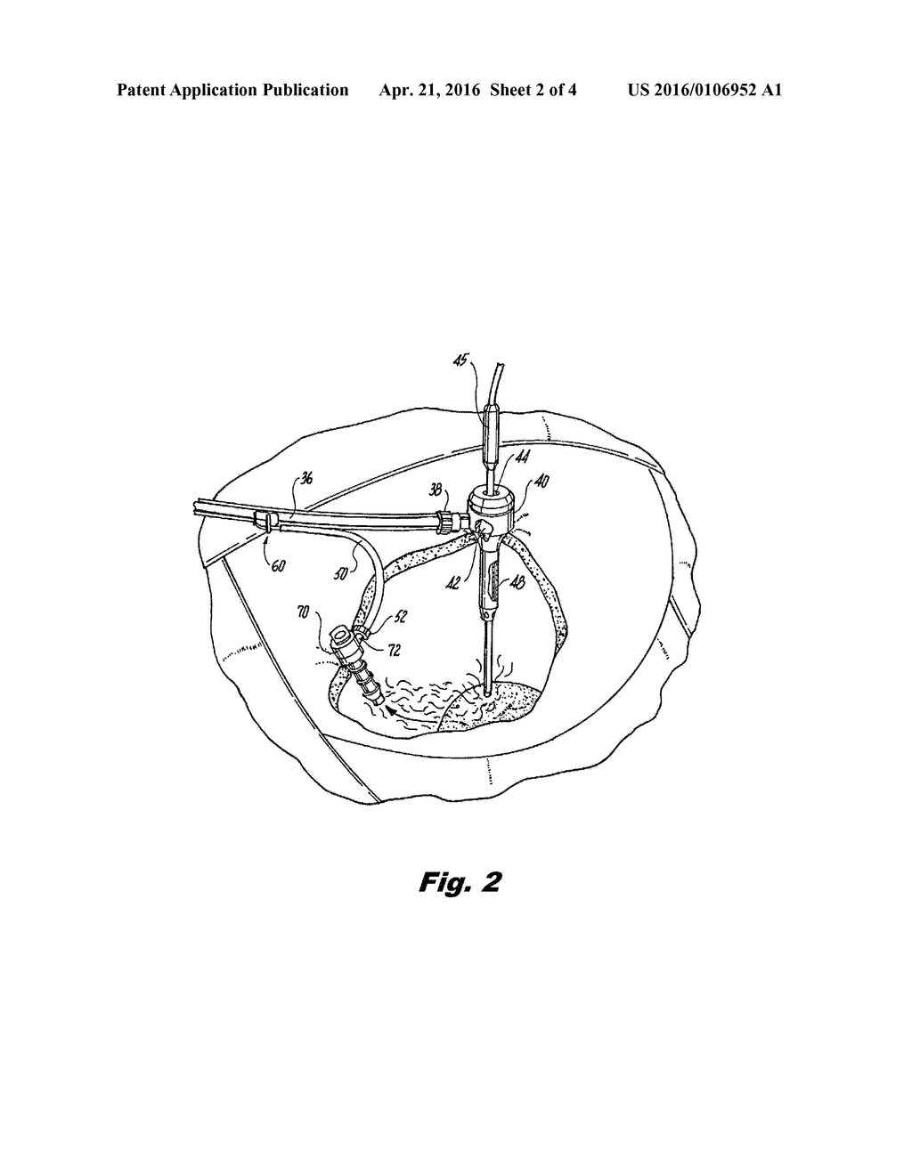 BRANCHING MULTI-LUMEN TUBE SET FOR LAPAROSCOPIC SURGICAL PROCEDURES     INVOLVING SMOKE EVACUATION - diagram, schematic, and image 03