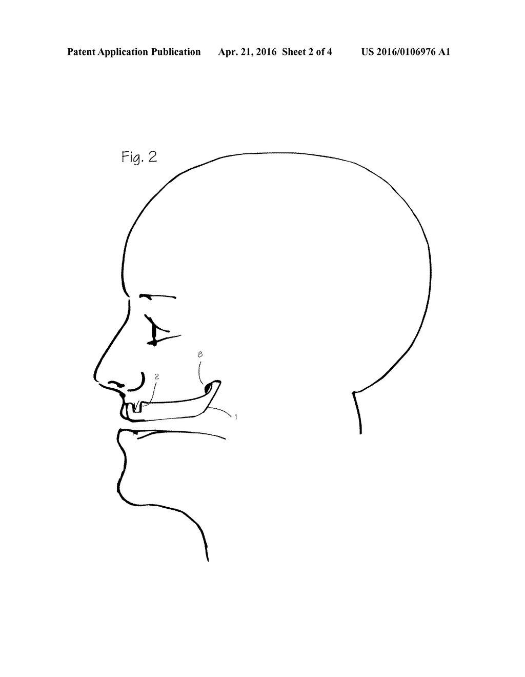 DEVICE AND METHOD FOR TREATMENT OF SLEEP APNEA - diagram, schematic, and image 03