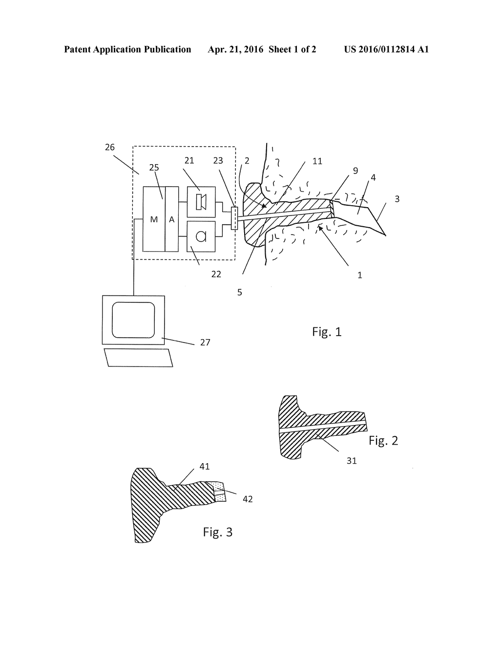 METHOD OF FITTING A HEARING INSTRUMENT, AND IMPRESSION TOOL - diagram, schematic, and image 02
