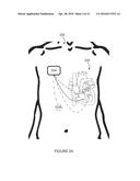 DETECTION AND MONITORING USING HIGH FREQUENCY ELECTROGRAM ANALYSIS diagram and image